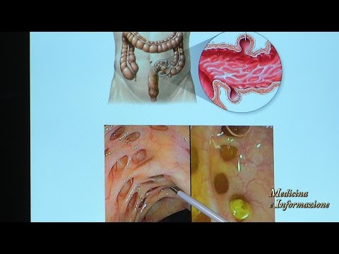 Diverticoli intestinali: cause, sintomi e possibilità di scomparsa