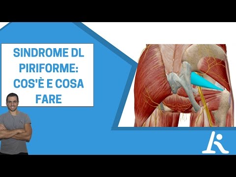 Infiammazione del muscolo piriforme: fa bene camminare?