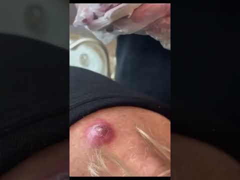 Punti neri giganti: come rimuoverli e prevenirli