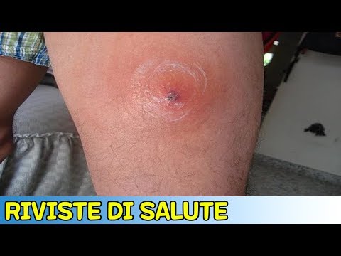 Puntura di pulce: sintomi, cure e prevenzione