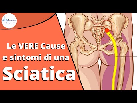 Sciatica: Riposo o camminare, qual è il trattamento migliore?