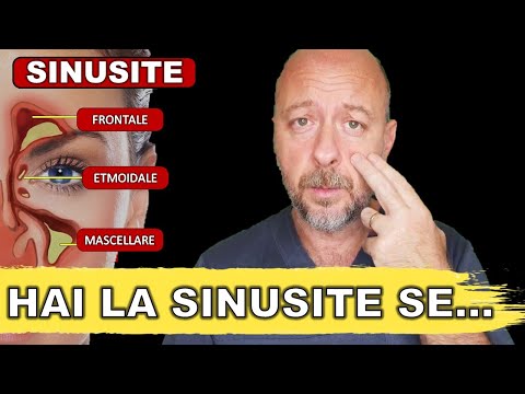 Sinusite senza muco: sintomi, cause e rimedi naturali